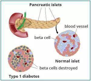 1型糖尿病最新疗法